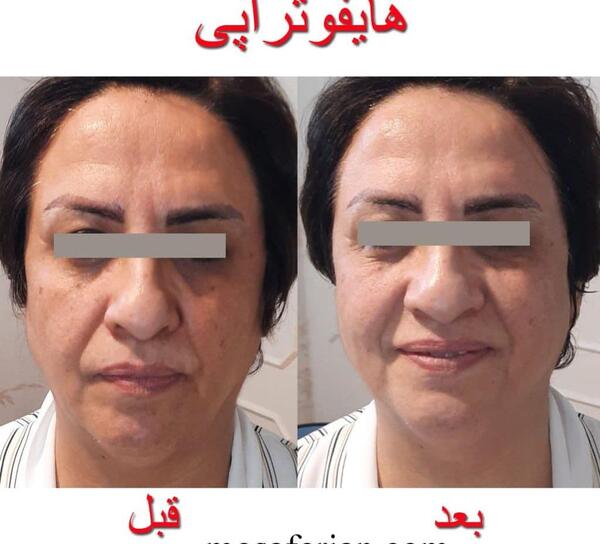 عکس قبل و بعد لاغری نی نی سایت