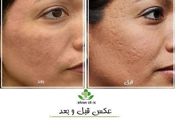 عکس قبل و بعد لاغری نی نی سایت