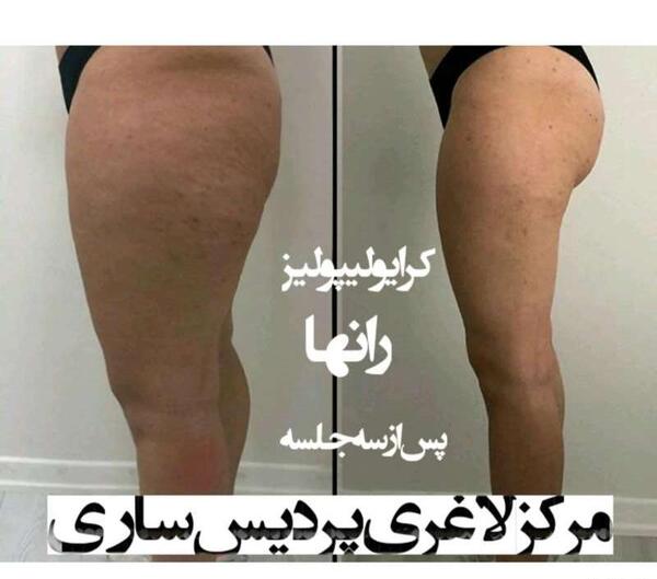 عکس قبل و بعد لاغری صورت