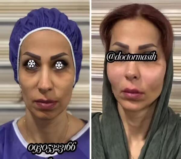 عکس قبل و بعد لاغری صورت