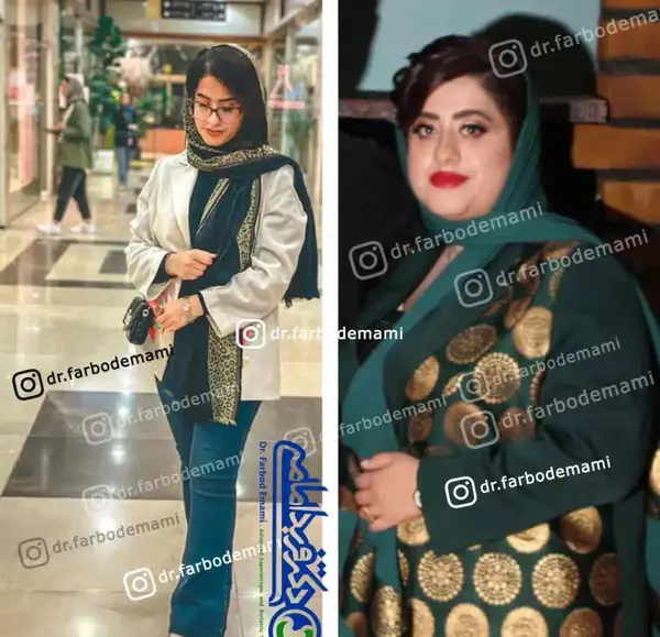 عکس قبل و بعد لاغری صورت