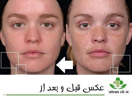 عکس قبل و بعد از لیزر پوست صورت