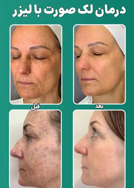 عکس قبل و بعد از لیزر پوست صورت