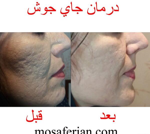 عکس قبل و بعد از لیزر پوست صورت