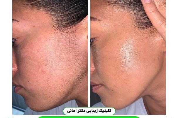 عکس قبل و بعد از لیزر پوست صورت