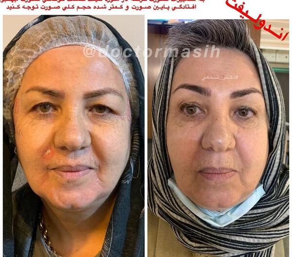 عکس قبل و بعد از لیزر پوست صورت