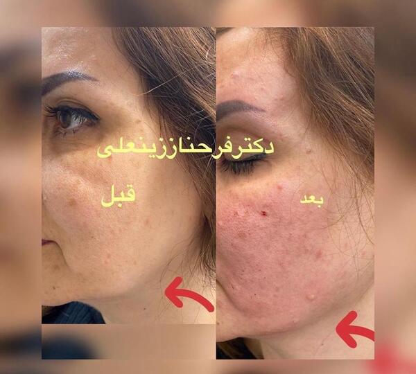 عکس قبل و بعد از لیزر پوست صورت