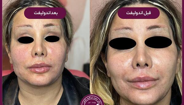 عکس قبل و بعد از لیزر پوست صورت