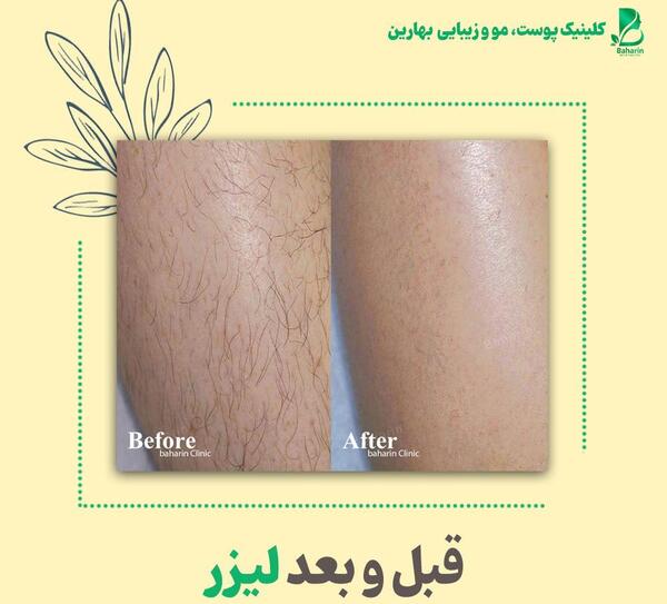 عکس قبل و بعد از لیزر پوست بدن