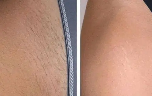 عکس قبل و بعد از لیزر پوست بدن
