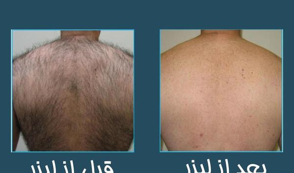 عکس قبل و بعد از لیزر ترک پوست