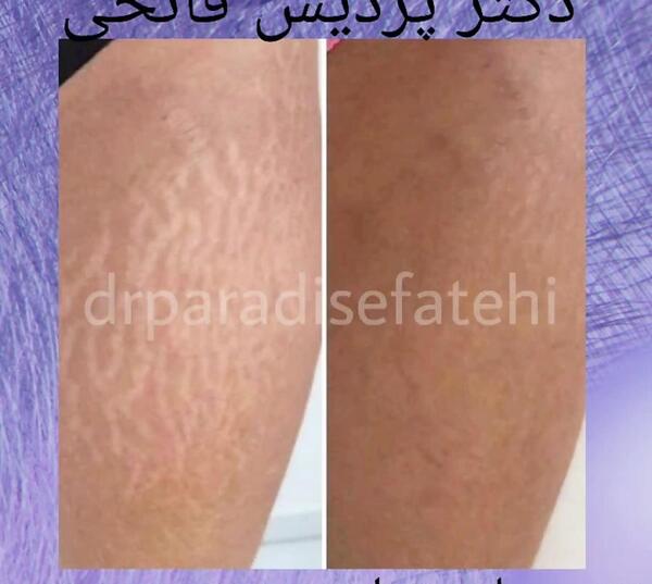 عکس قبل و بعد از لیزر ترک پوست