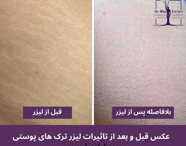 عکس قبل و بعد از لیزر ترک پوست