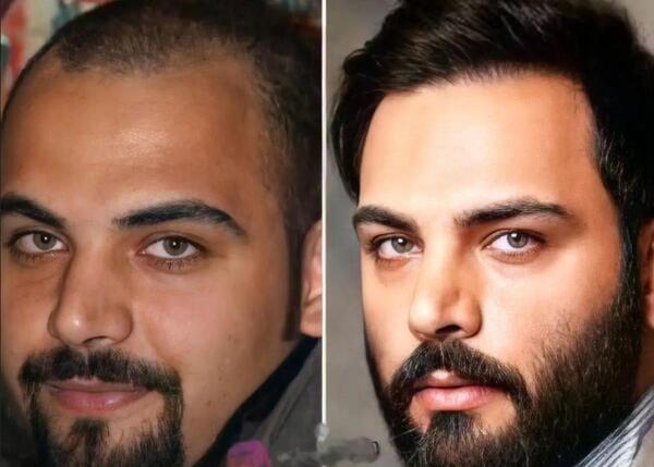 عکس های قبل از عمل زیبایی احسان علیخانی