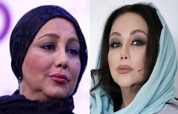 عکس های قبل از عمل زیبایی احسان علیخانی