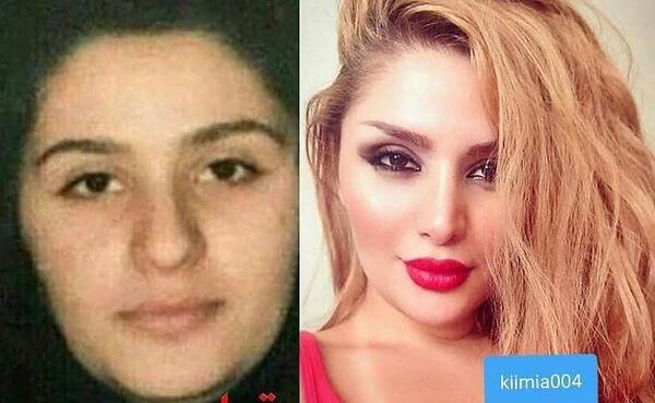 عکس قبل از عمل جراحی دنیا جهانبخت