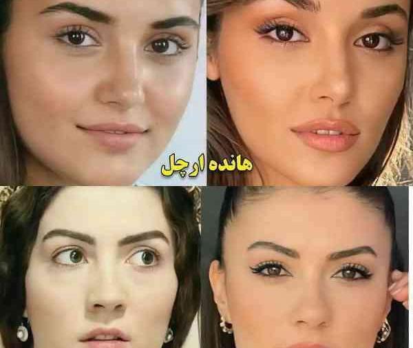 عکس قبل و بعد عمل هانده ارچل