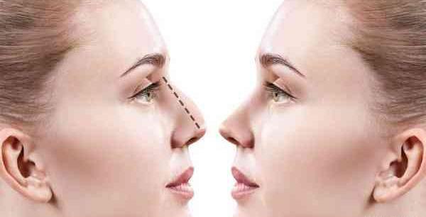 عکس های قبل عمل هانده ارچل