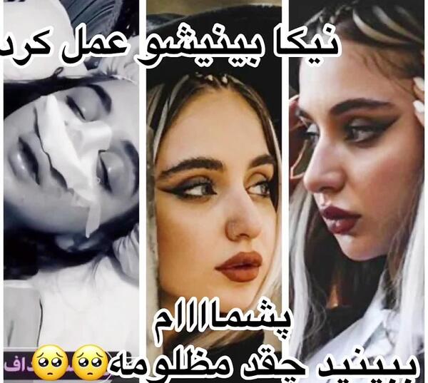 عکس قبل عمل بینی هانده ارچل