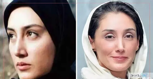 عکس قبل از عمل بینی بهنوش بختیاری