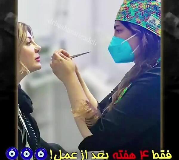 عکس قبل از عمل بینی بهنوش بختیاری