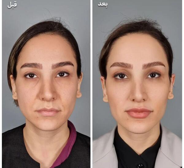 عکس قبل و بعد آرایش
