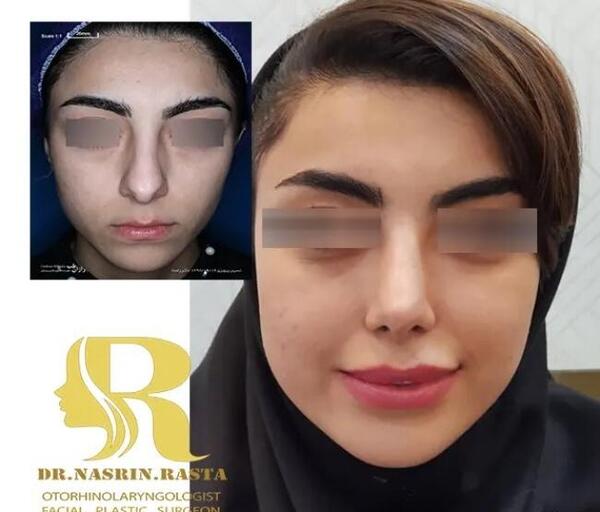 عکس انجلینا جولی قبل از عمل بینی