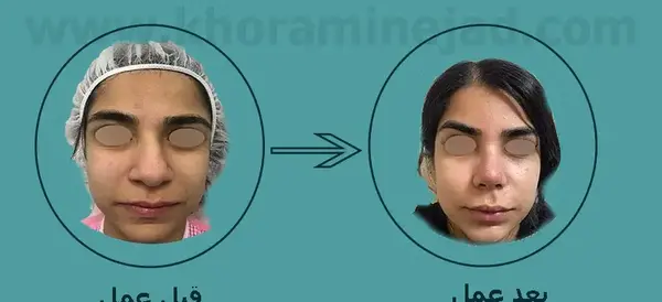 عکس قبل و بعد عمل بینی گوشتی نی نی سایت