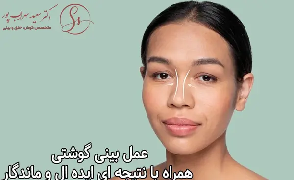 عکس قبل و بعد عمل بینی گوشتی نی نی سایت