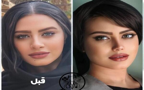 عکس قبل و بعد عمل بینی گوشتی نی نی سایت