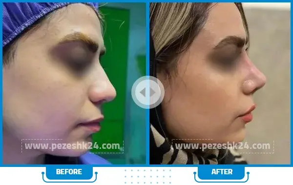 عکس قبل و بعد عمل بینی گوشتی نی نی سایت