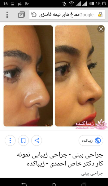 عکس قبل و بعد عمل بینی گوشتی نی نی سایت