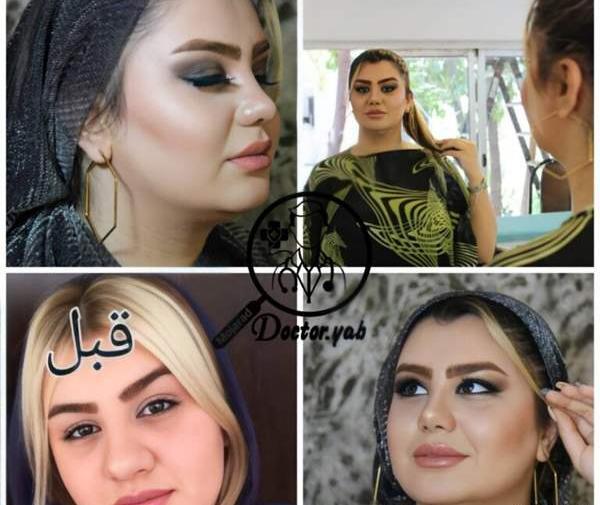 عکس قبل و بعد عمل بینی گوشتی نی نی سایت