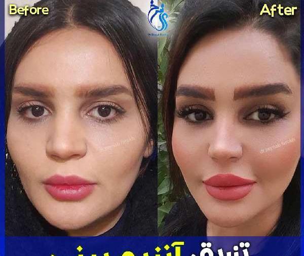 عکس قبل و بعد عمل بینی گوشتی نی نی سایت