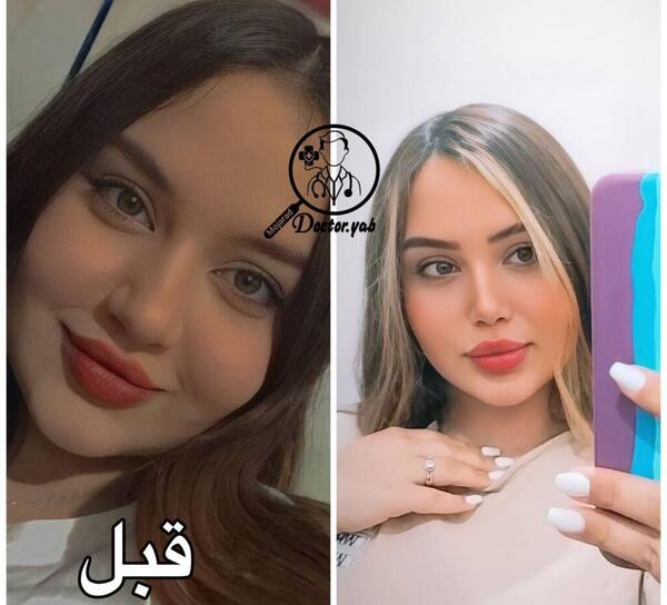 عکس قبل و بعد عمل بینی گوشتی نی نی سایت