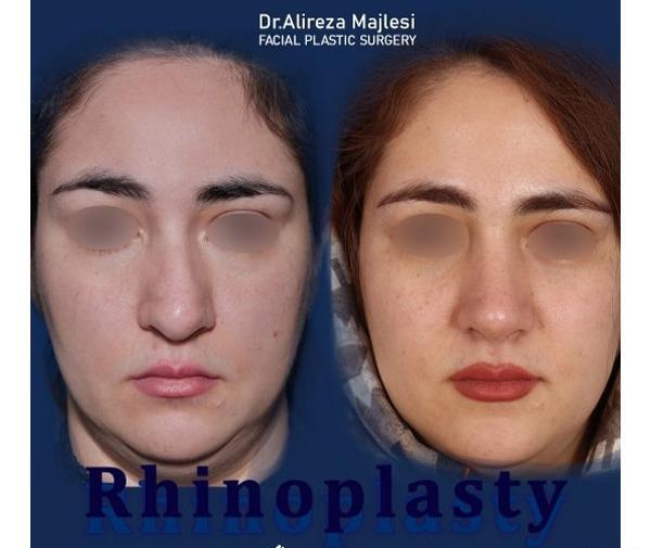 عکس قبل و بعد عمل بینی استخوانی
