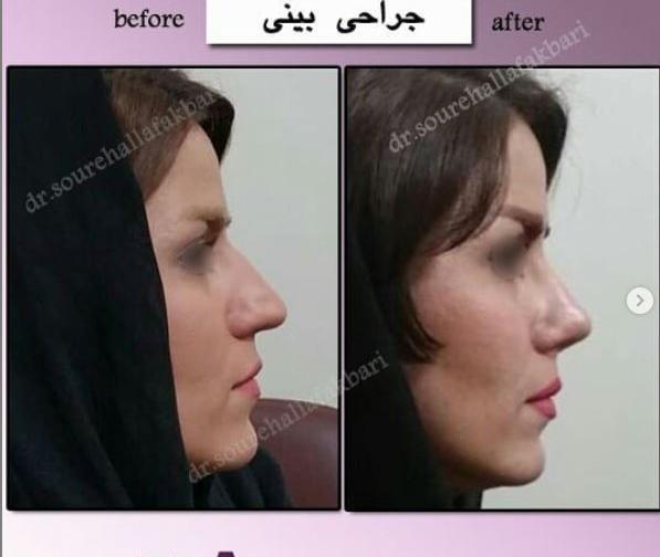 عکس قبل و بعد عمل بینی استخوانی