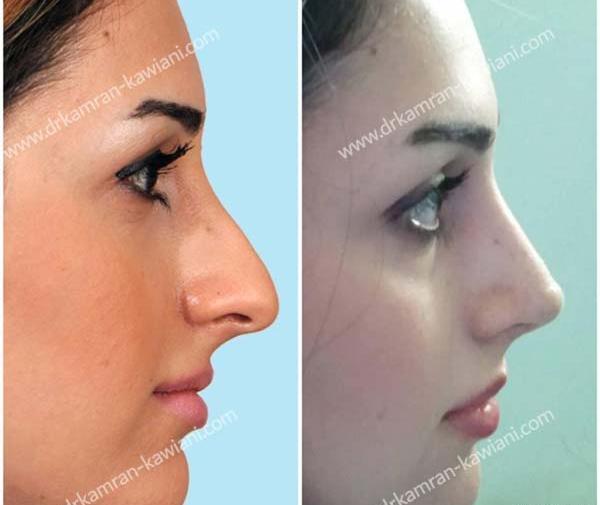 عکس قبل و بعد عمل بینی استخوانی