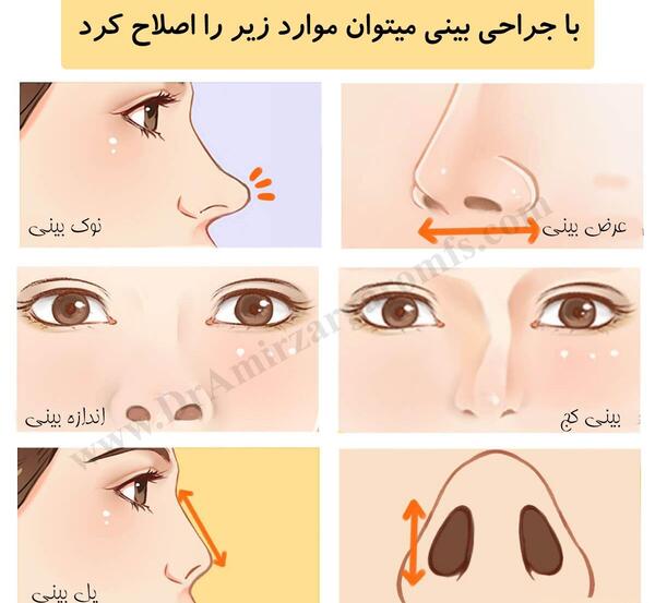 عکس قبل و بعد عمل بینی استخوانی