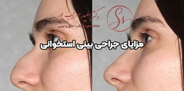 عکس قبل و بعد عمل بینی استخوانی