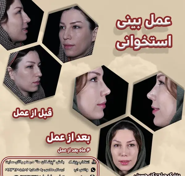 عکس قبل و بعد عمل بینی استخوانی
