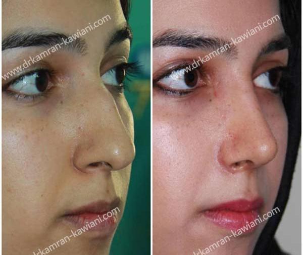 عکس قبل و بعد عمل بینی استخوانی