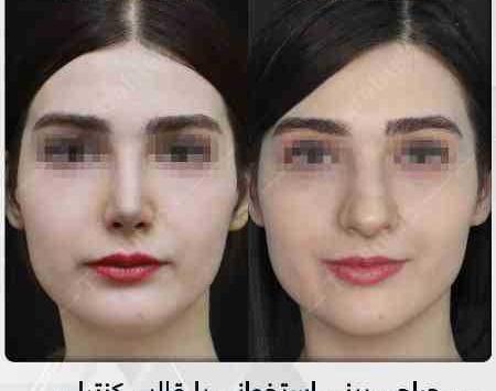 عکس قبل و بعد عمل بینی استخوانی