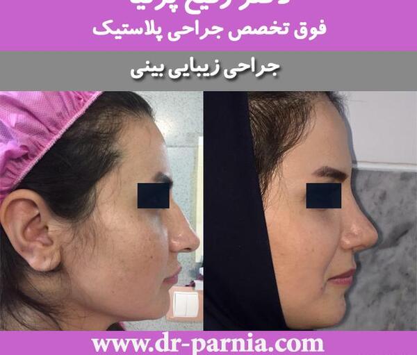 عکس قبل و بعد عمل بینی استخوانی