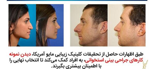 عکس قبل و بعد عمل بینی استخوانی