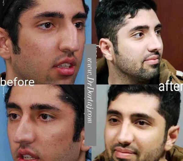 عکس قبل و بعد عمل بینی استخوانی