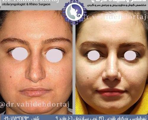 عکس قبل و بعد عمل بینی استخوانی