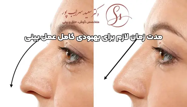 عکس قبل و بعد عمل بینی استخوانی