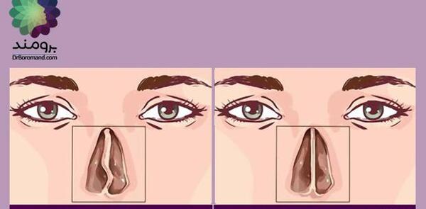 عکس قبل و بعد عمل انحراف بینی