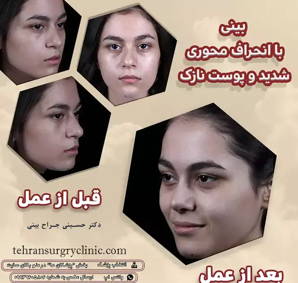 عکس قبل و بعد عمل انحراف بینی